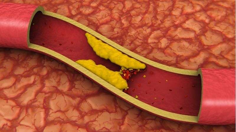 Mbyllja e arteries së këmbës