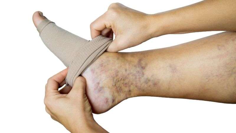 Trajtimi jo-kirurgjikal i venave me variçe (lazer, skleroterapi, radiofrekuencë, ablacion me mikrovalë)